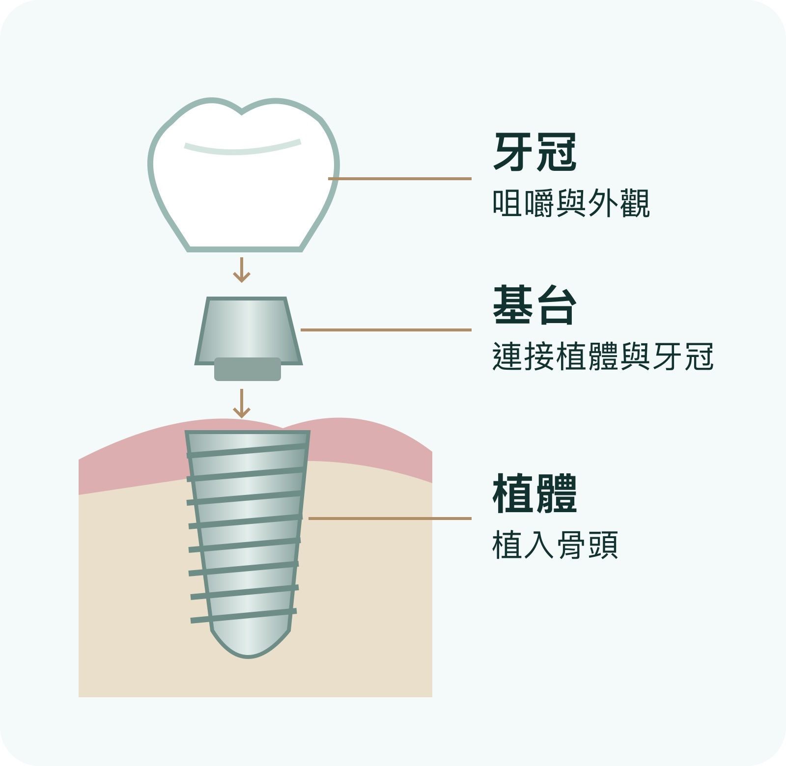 植體、基台與牙冠的連接位置及功能
