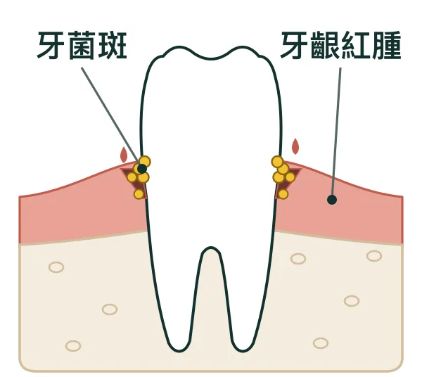 牙齦炎:牙齦紅腫流血,牙菌斑堆積,骨頭尚未受影響