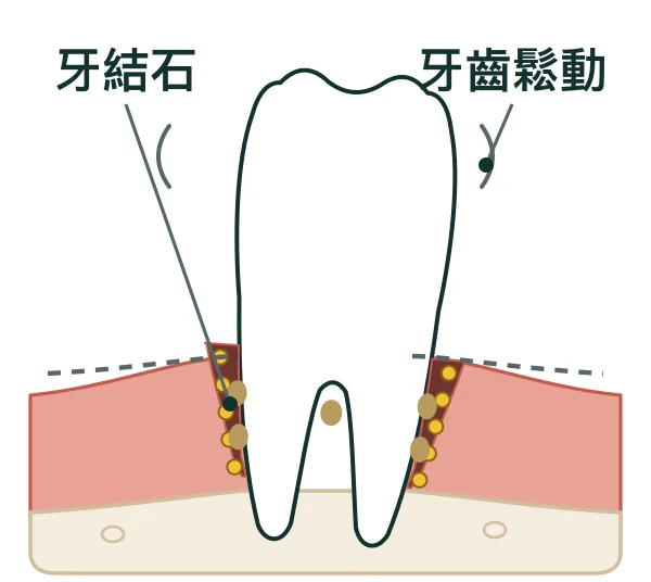 重度牙周炎:囊袋很深,骨頭大量流失,牙齒鬆動、移位